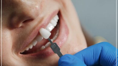 هزینه ونیر کامپوزیت و لمینت در قیطریه – لیست قیمت خدمات زیبایی 1404